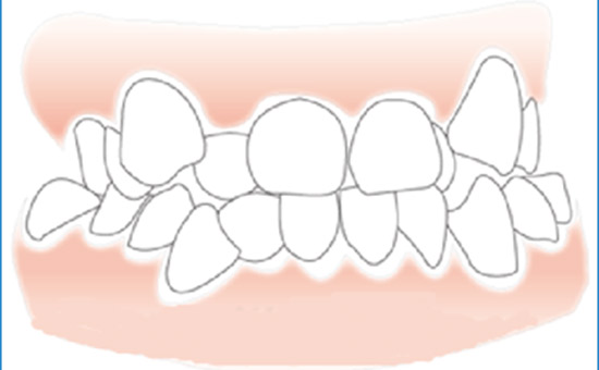 牙齿畸形儿童矫正