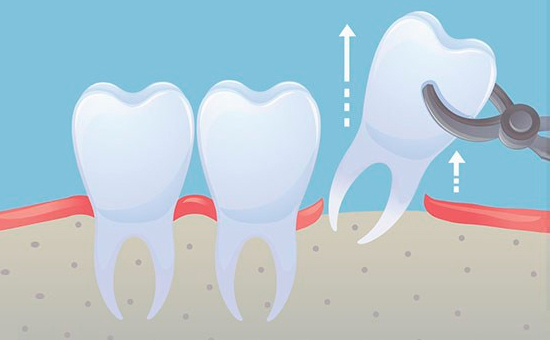 智齿不疼拔不拔，牙博士医生解答