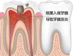 中重度龋齿