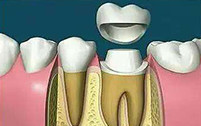 根管治疗后套牙冠