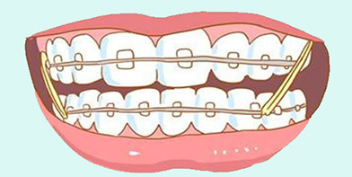 牙齿矫正类价格详情