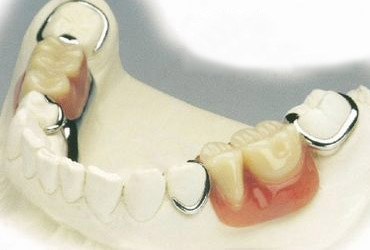 牙博士镶牙技术