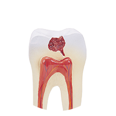 牙体断折牙髓外露刺激
